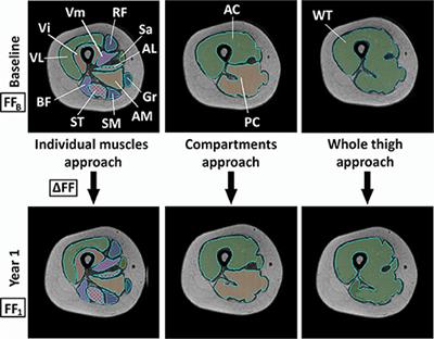 Different Approaches to Analyze Muscle Fat Replacement With Dixon MRI in Pompe Disease